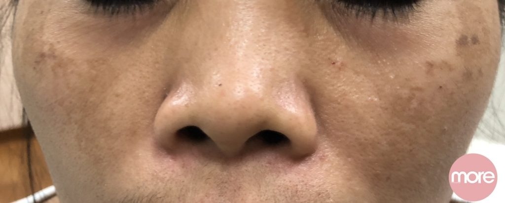 醫生拆解荷爾蒙斑成因＋治療去除方法！3間去斑醫美店舖推薦