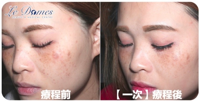 荷爾蒙斑 只接受了一次M22脈衝光去斑療法，部份斑已清除，其餘的荷爾蒙斑也減淡了。