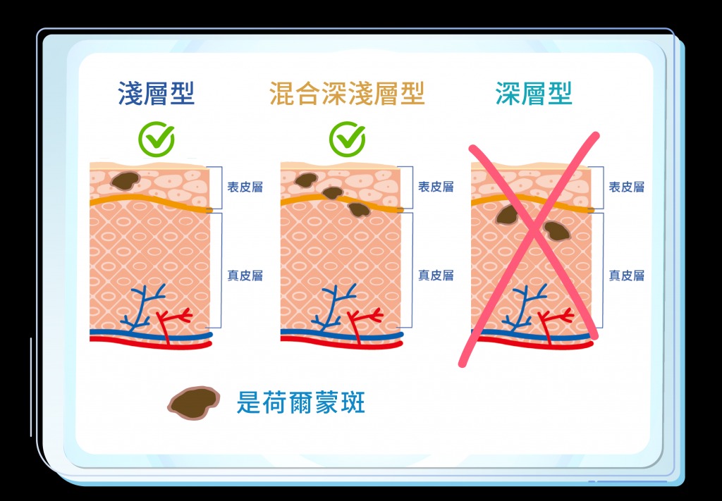 荷爾蒙斑 Le Domes Beaute創辦人姜博士表示根據多項醫學文獻顯示『荷爾蒙斑主要是淺層斑為主』，只有《淺層型荷爾蒙層斑》及《混合深淺層型荷爾蒙斑》，並無真正《深層型》荷爾蒙斑患者。