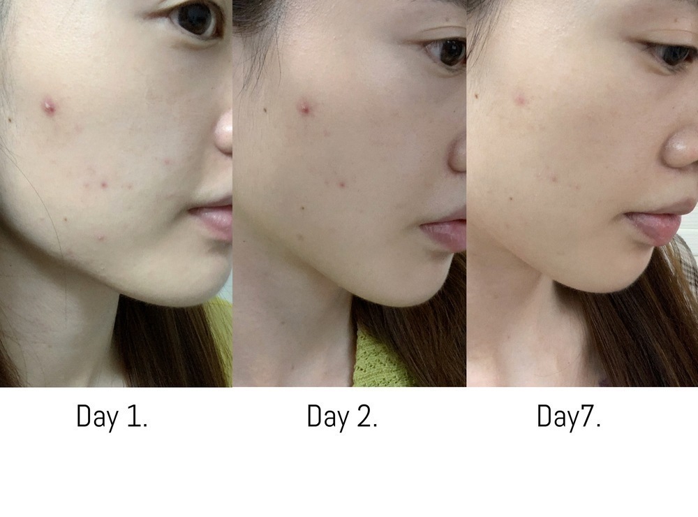 Dewytree 暗瘡消炎液 解決 膏 acne 方法 黑頭粉刺 祛痘 暗瘡印 膿 好用 推薦 