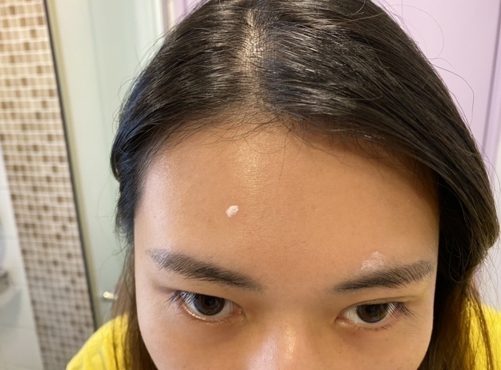 Dewytree 暗瘡消炎液 解決 膏 acne 方法 黑頭粉刺 祛痘 暗瘡印 膿 好用 推薦 