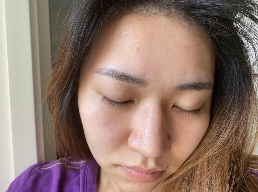 Dewytree 暗瘡消炎液 解決 膏 acne 方法 黑頭粉刺 祛痘 暗瘡印 膿 好用 推薦 