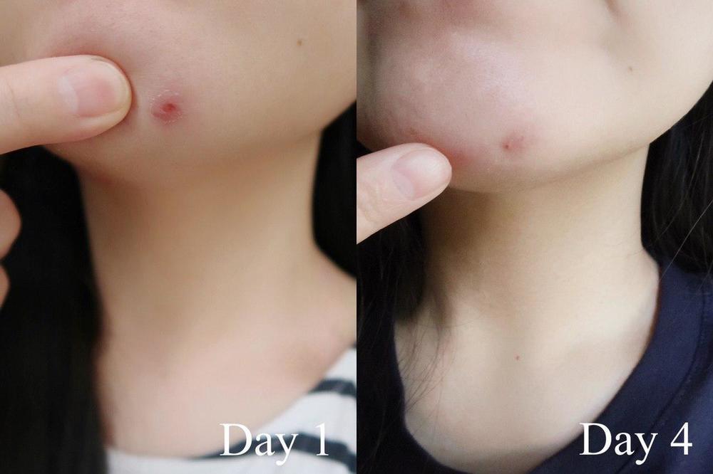 Dewytree 暗瘡消炎液 解決 膏 acne 方法 黑頭粉刺 祛痘 暗瘡印 膿 好用 推薦 